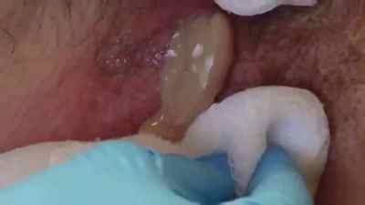 Фурункул на генітальних органах жінок і як його лікувати на статевих губах