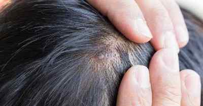 Фурункул на голові в волоссі: причини і лікування