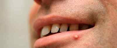 Фурункул на губі: симптоми і лікування