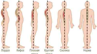Фізіологічні вигини хребта: скільки вигинів утворює хребет людини, прямий хребет без вигинів, природні вигини | Ревматолог