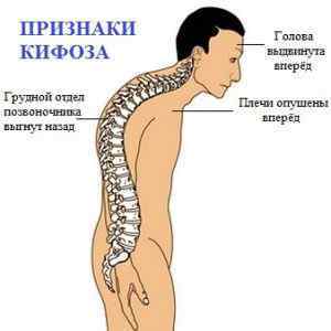 Фізіологічні вигини хребта: скільки вигинів утворює хребет людини, прямий хребет без вигинів, природні вигини | Ревматолог