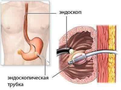 Гастростомія, гастростома: операція накладення, харчування через неї