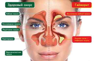 Гайморит без нежиті (соплів) і закладеності носа: причини, симптоми і лікування