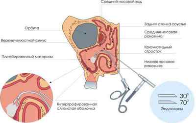 Гайморотомія: операція і її проведення, показання, результат