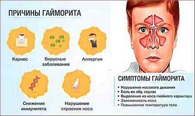 Гайморові пазухи: розташування, хвороби і їх лікування