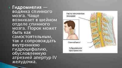 Гідроміелія хребта: симптоми і лікування гідроміеліі грудного відділу хребта, розширення спинномозкового каналу | Ревматолог