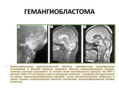 Гемангіобластома мозочка головного мозку причини, симптоми і лікування