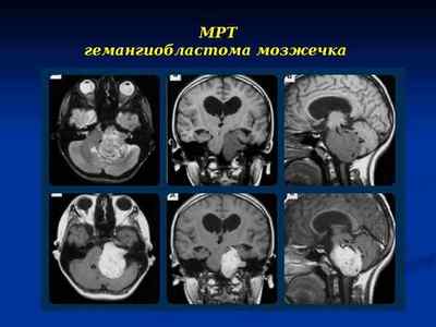 Гемангіобластома мозочка головного мозку причини, симптоми і лікування