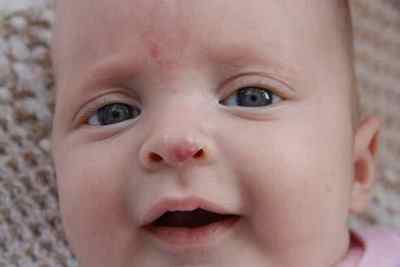 Гемангіома носа: лікування новоутворення