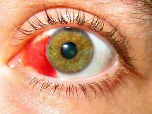 Гемофтальм очі: причини і лікування часткової патології