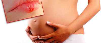 Герпес на губах при вагітності: лікування та наслідки