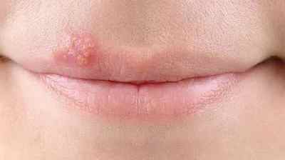 Герпес на губах: швидке лікування в домашніх умовах