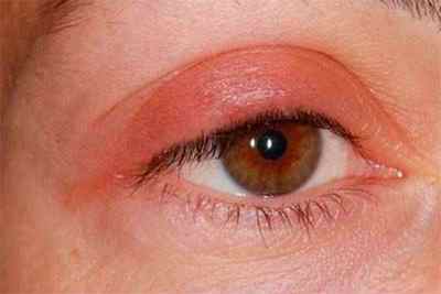 Герпес на оці: лікування очного герпесу на столітті, фото, симптоми, як лікувати