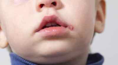 Герпес у дітей: симптоми, види та лікування (фото)