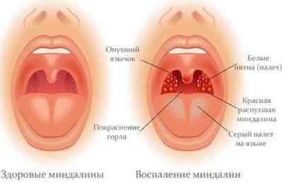 Герпес в носі: симптоми і лікування у дорослих і дітей