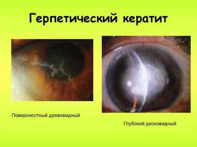 Герпетичний кератит: лікування, симптоми захворювання ока (герпесної, деревовидного)