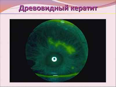 Герпетичний кератит: лікування, симптоми захворювання ока (герпесної, деревовидного)
