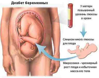 Гестаційний цукровий діабет при вагітності: симптоми і лікування