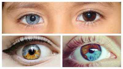 Гетерохромія очей (різний колір): чому у людей бувають різнокольорові очі, причини
