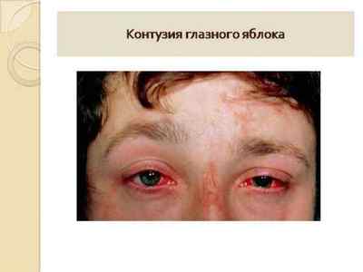Гіфема очі: лікування крововиливу в передню камеру, симптоми