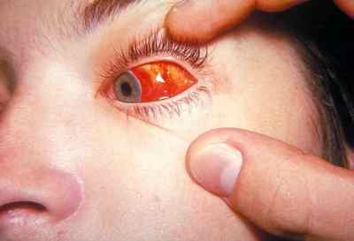 Гіфема очі: лікування крововиливу в передню камеру, симптоми
