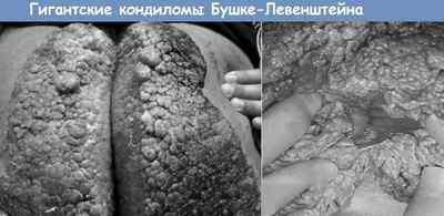 Гігантська кондилома Бушко-Левенштейна: причини і лікування