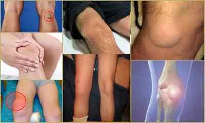 Гігрома колінного суглоба: фото, симптоми, лікування