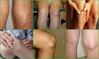 Гігрома колінного суглоба: фото, симптоми, лікування