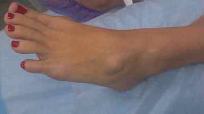 Гігрома стопи у людини: фото і лікування ноги у дитини, як лікувати без операції народними засобами кісту | Ревматолог