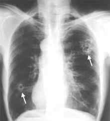 Глисти у легких у людини: симптоми і ознаки, лікування легеневих паразитів