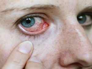 Глисти у очах: симптоми паразитів, лікування очних червяків у людини, фото