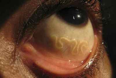 Глисти у очах: симптоми паразитів, лікування очних червяків у людини, фото
