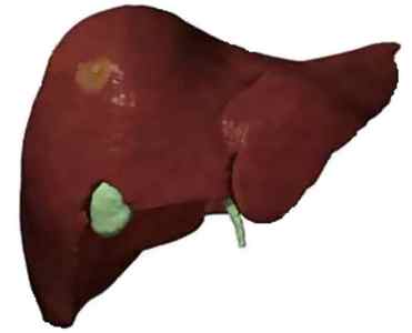 Глисти у печінці людини: симптоми, як вивести печінкові гельмінти, фото і лікування