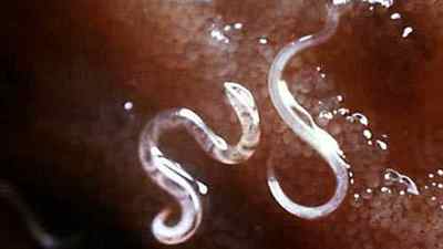 Глисти у шлунку людини: фото і симптоми червяків в животі