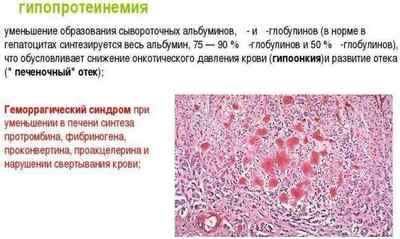 Гломерулонефрит: симптоми і лікування у дорослих і дітей