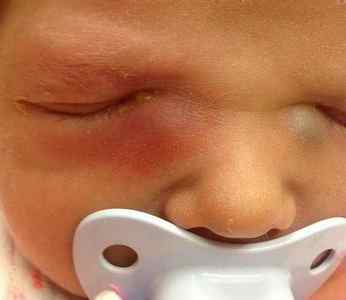 Гноїться очей у новонародженого, ніж лікувати і промити, якщо загноїлося у дитини