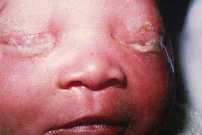 Гноїться очей у новонародженого, ніж лікувати і промити, якщо загноїлося у дитини