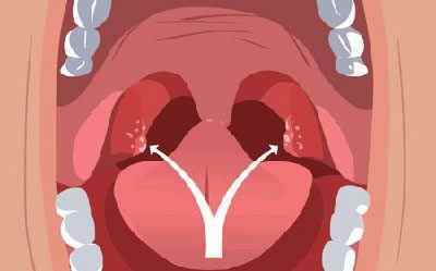 Гнійні і казеозние пробки в горлі (на мигдалинах): причини, лікування