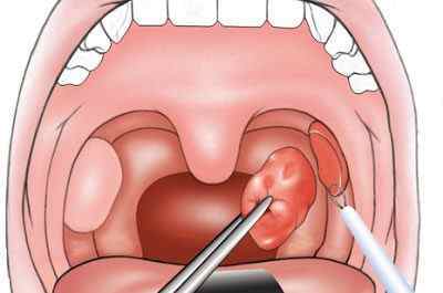 Гнійні і казеозние пробки в горлі (на мигдалинах): причини, лікування