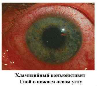 Гнійний конюнктивіт у дітей і дорослих: лікування очей, причини, ніж лікувати