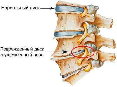 Головний біль при остеохондрозі шийного відділу хребта: симптоми і лікування запаморочень препаратами | Ревматолог