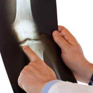 Гонартроз колінних суглобів 1-3 ступеня: симптоми і лікування народними засобами, що це таке, двосторонній гонартроз, вправи | Ревматолог