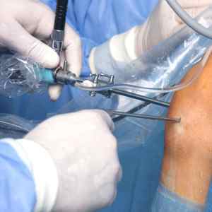 Гонартроз колінних суглобів 1-3 ступеня: симптоми і лікування народними засобами, що це таке, двосторонній гонартроз, вправи | Ревматолог