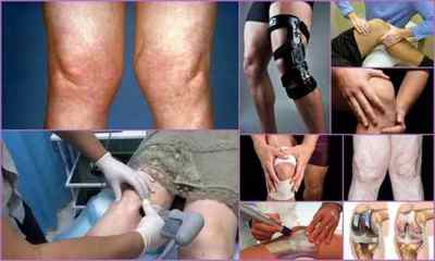 Гонартроз колінного суглоба 3 4 ступеня - лікування і симптоми