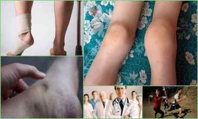 Гонартроз колінного суглоба: симптоми, лікування, ступеня, фото, причини, діагностика