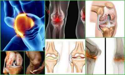 Гонартріт колінного суглоба 12 3 ступеня - симтомов і лікування