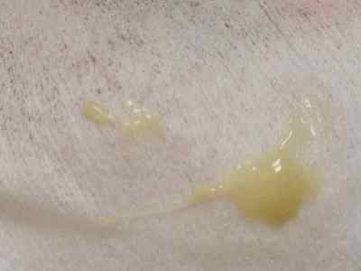 Гонококк Neisseria gonorrhoeae: що це таке, симптоми і лікування