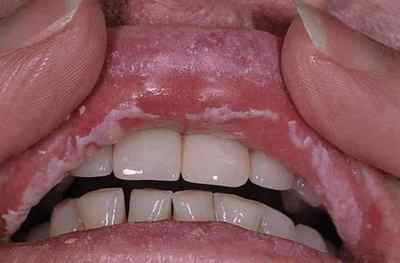 Гонорея в роті: основні симптоми патології