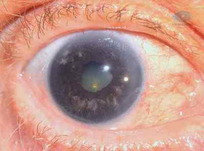 Гоніоскопія очі: опис, застосування гелів для лікування