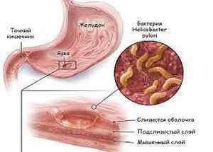 Гостра виразка шлунка: симптоми, види, код за МКХ-10 лікування, дієтотерапія